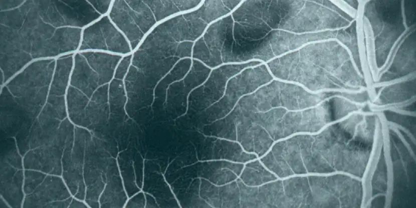 Fluorescein angiography