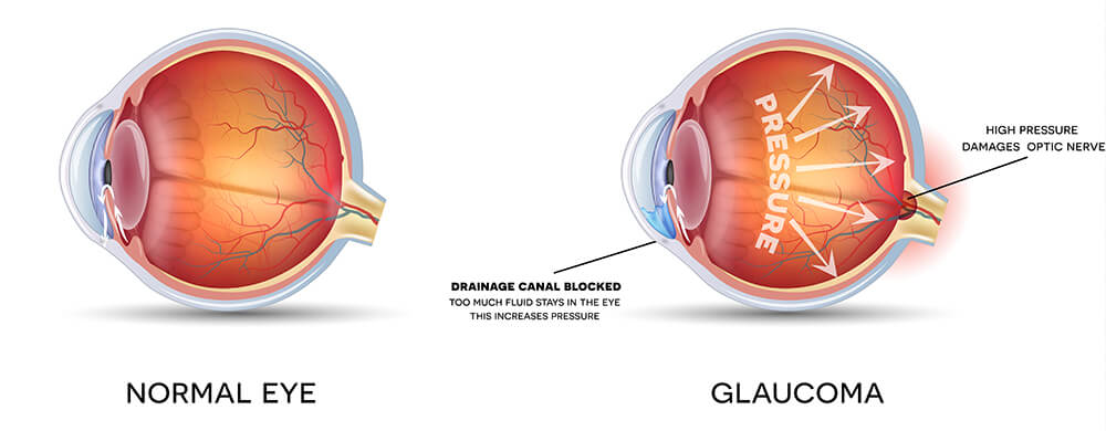 Chart Showing a Healthy Eye Compared to One With Glaucoma