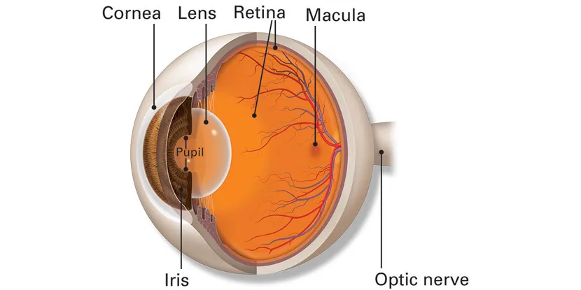 Retinal tearing